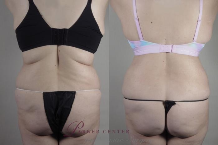 Tummy Tuck Case 1374 Before & After back with bra  | Paramus, NJ | Parker Center for Plastic Surgery