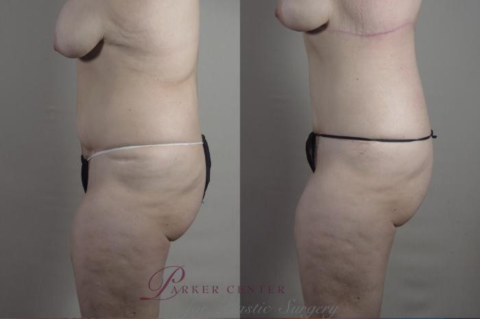 Tummy Tuck Case 1374 Before & After Left Side | Paramus, NJ | Parker Center for Plastic Surgery