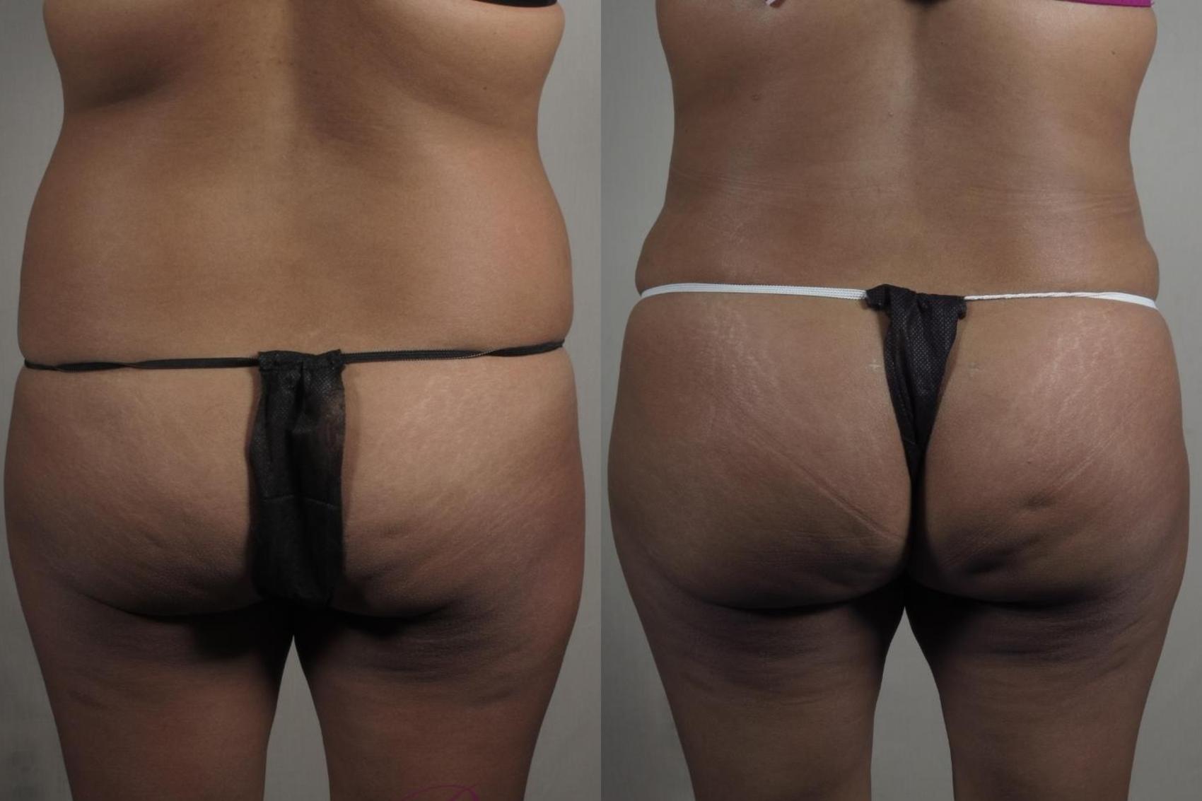 Tummy Tuck Case 1381 Before & After Back | Paramus, New Jersey | Parker Center for Plastic Surgery