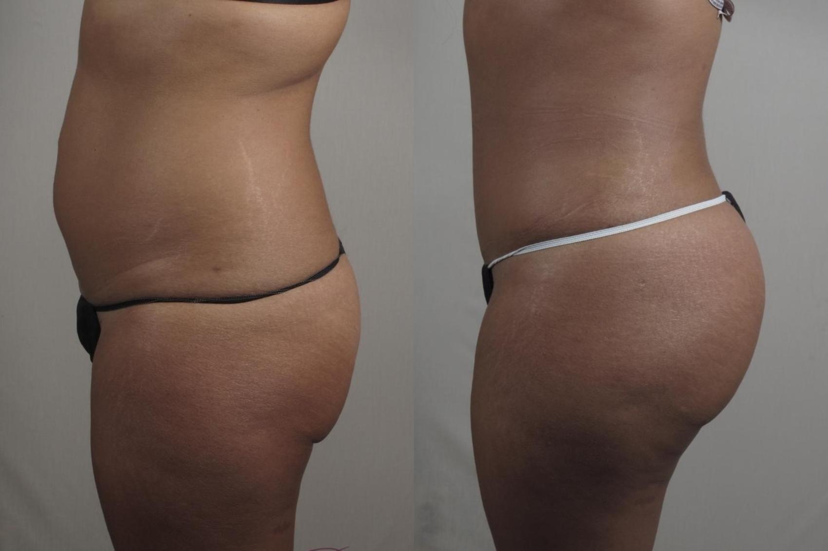 Tummy Tuck Case 1381 Before & After Left Side | Paramus, New Jersey | Parker Center for Plastic Surgery