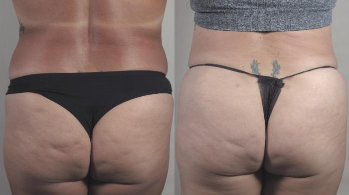 Tummy Tuck Case 1396 Before & After Back | Paramus, New Jersey | Parker Center for Plastic Surgery