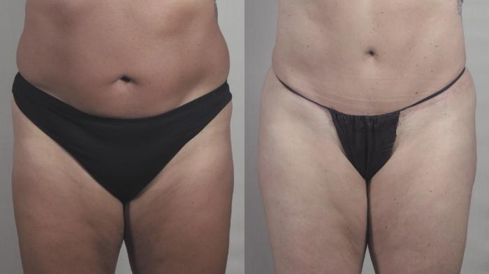 Tummy Tuck Case 1396 Before & After Front | Paramus, New Jersey | Parker Center for Plastic Surgery