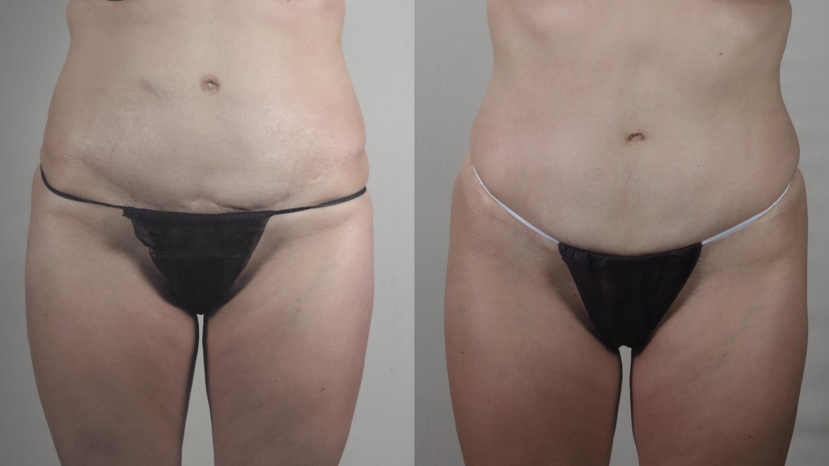 Tummy Tuck Case 1400 Before & After Front | Paramus, New Jersey | Parker Center for Plastic Surgery