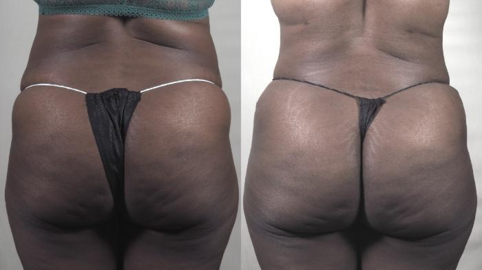 Tummy Tuck Case 1405 Before & After Back View | Paramus, New Jersey | Parker Center for Plastic Surgery