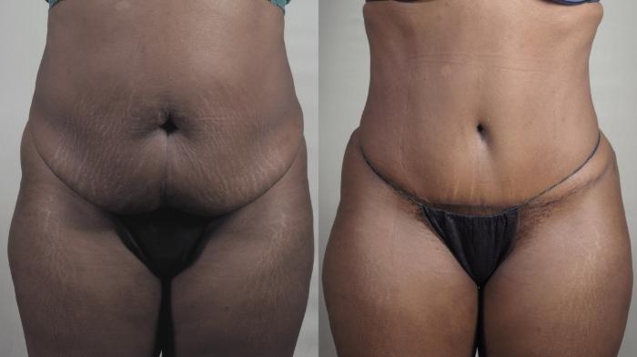 Tummy Tuck Case 1405 Before & After Front View | Paramus, New Jersey | Parker Center for Plastic Surgery