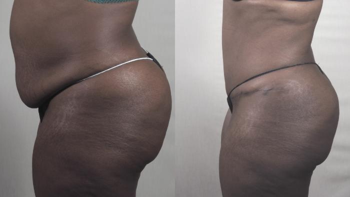 Tummy Tuck Case 1405 Before & After Left Side | Paramus, New Jersey | Parker Center for Plastic Surgery