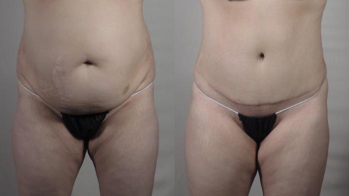 Tummy Tuck Case 1415 Before & After Front | Paramus, New Jersey | Parker Center for Plastic Surgery