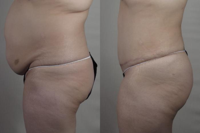 Tummy Tuck Case 1415 Before & After Side view | Paramus, New Jersey | Parker Center for Plastic Surgery