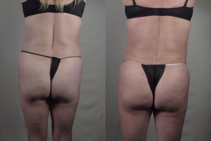 Tummy Tuck Case 1417 Before & After Back | Paramus, New Jersey | Parker Center for Plastic Surgery