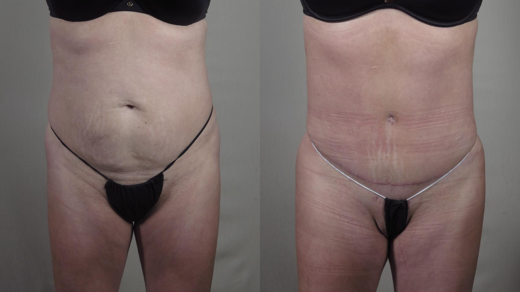 Tummy Tuck Case 1417 Before & After Front | Paramus, New Jersey | Parker Center for Plastic Surgery