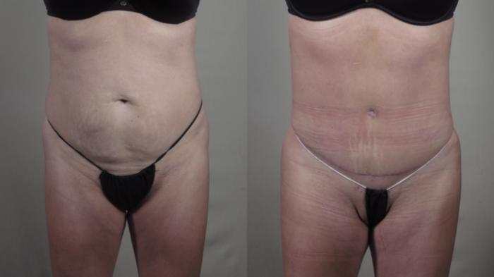 Tummy Tuck Case 1417 Before & After Front | Paramus, New Jersey | Parker Center for Plastic Surgery