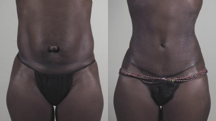 Tummy Tuck Case 1455 Before & After Front | Paramus, New Jersey | Parker Center for Plastic Surgery