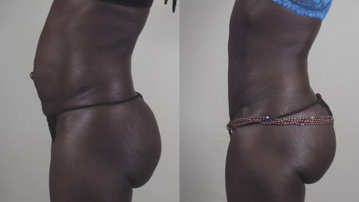 Tummy Tuck Case 1455 Before & After Left Side | Paramus, New Jersey | Parker Center for Plastic Surgery