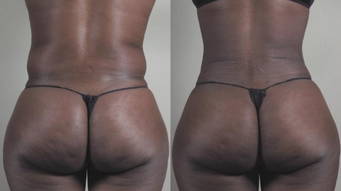 Liposuction Case 1460 Before & After Back | Paramus, New Jersey | Parker Center for Plastic Surgery