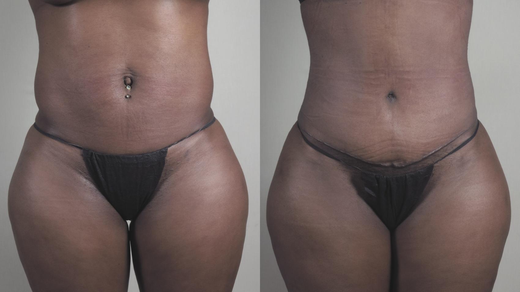 Tummy Tuck Case 1460 Before & After Front | Paramus, New Jersey | Parker Center for Plastic Surgery