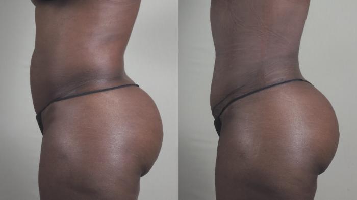 Liposuction Case 1460 Before & After Left Side | Paramus, New Jersey | Parker Center for Plastic Surgery