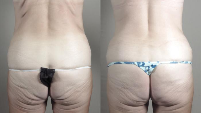 Tummy Tuck Case 1472 Before & After Back | Paramus, New Jersey | Parker Center for Plastic Surgery