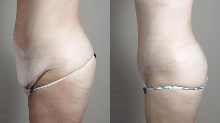 Tummy Tuck Case 1472 Before & After Left Side | Paramus, New Jersey | Parker Center for Plastic Surgery