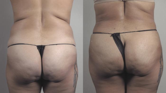 Tummy Tuck Case 1482 Before & After Back | Paramus, New Jersey | Parker Center for Plastic Surgery