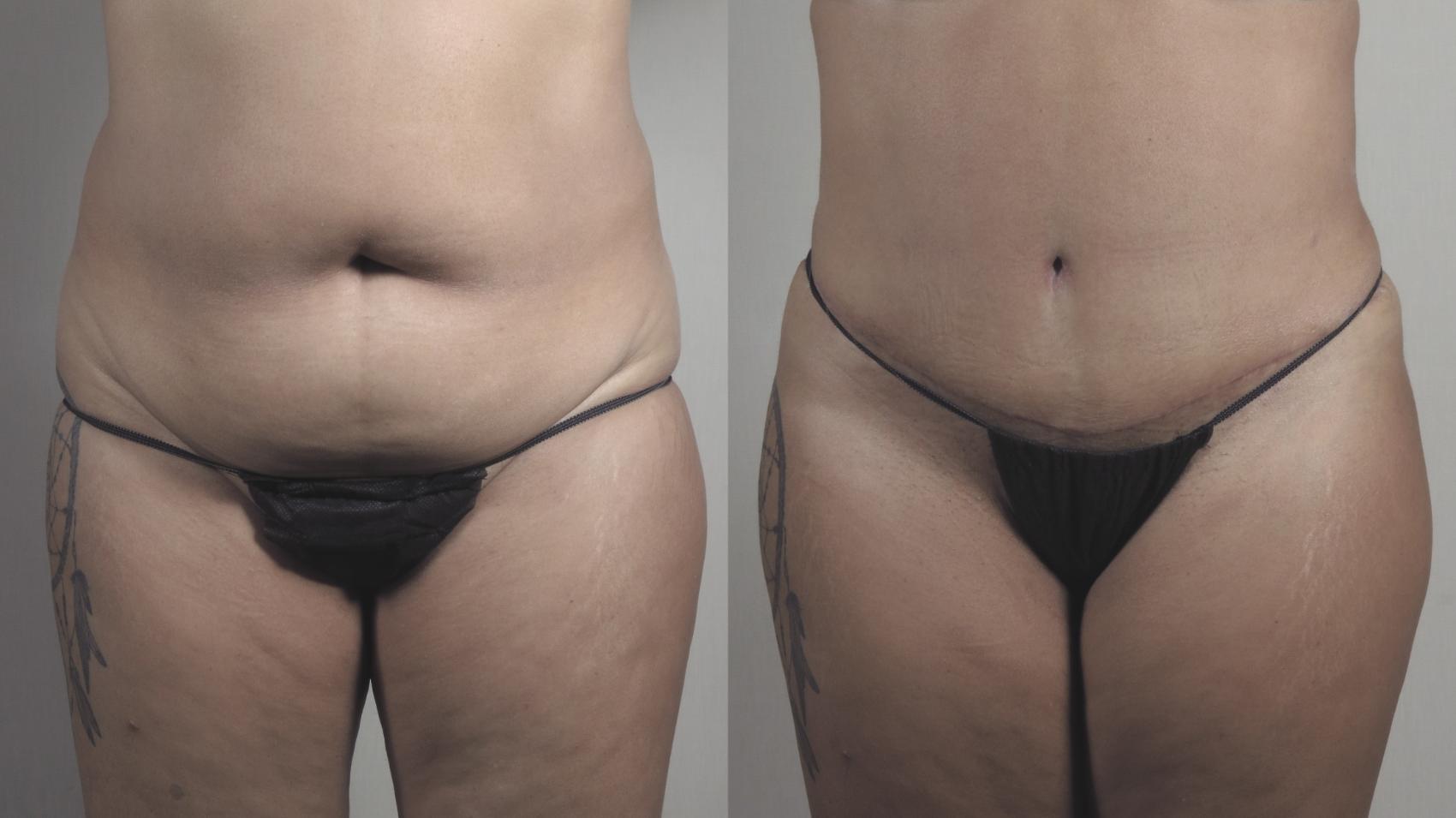 Tummy Tuck Case 1482 Before & After Front | Paramus, New Jersey | Parker Center for Plastic Surgery