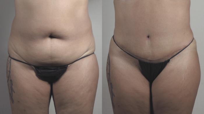 Tummy Tuck Case 1482 Before & After Front | Paramus, New Jersey | Parker Center for Plastic Surgery