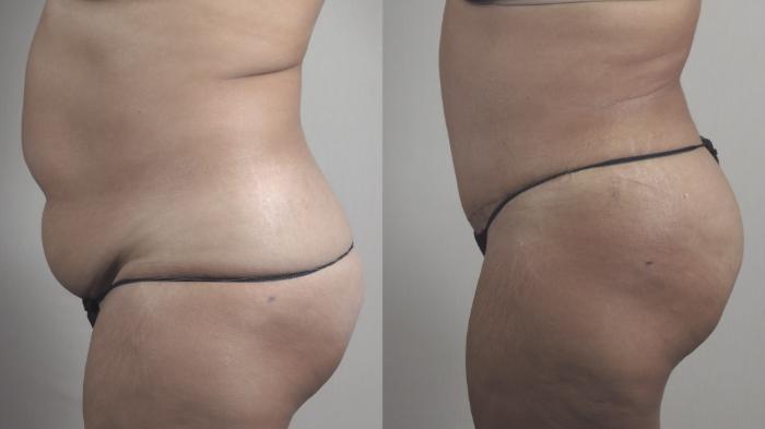 Tummy Tuck Case 1482 Before & After Left Side | Paramus, New Jersey | Parker Center for Plastic Surgery