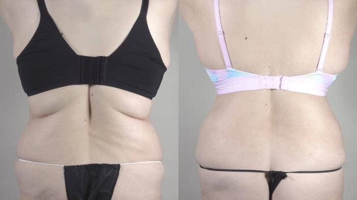 Tummy Tuck Case 1486 Before & After back 1 | Paramus, New Jersey | Parker Center for Plastic Surgery