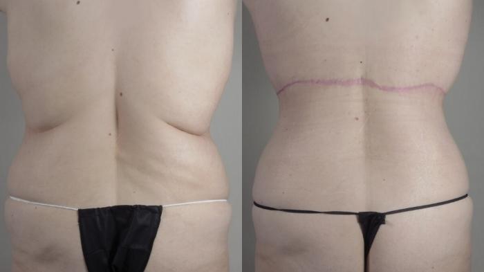 Tummy Tuck Case 1486 Before & After back2 | Paramus, New Jersey | Parker Center for Plastic Surgery