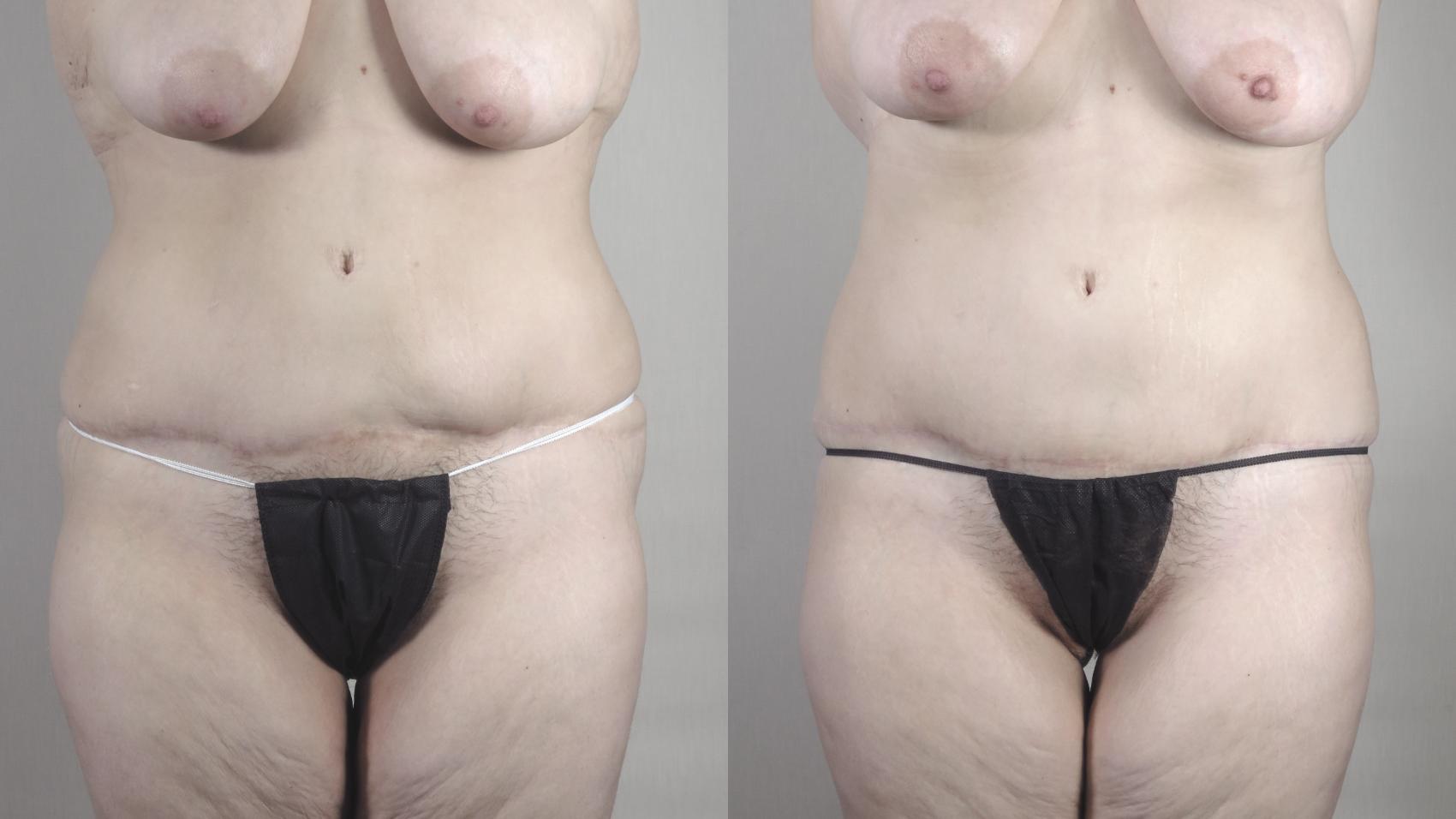 Tummy Tuck Case 1486 Before & After Front | Paramus, New Jersey | Parker Center for Plastic Surgery