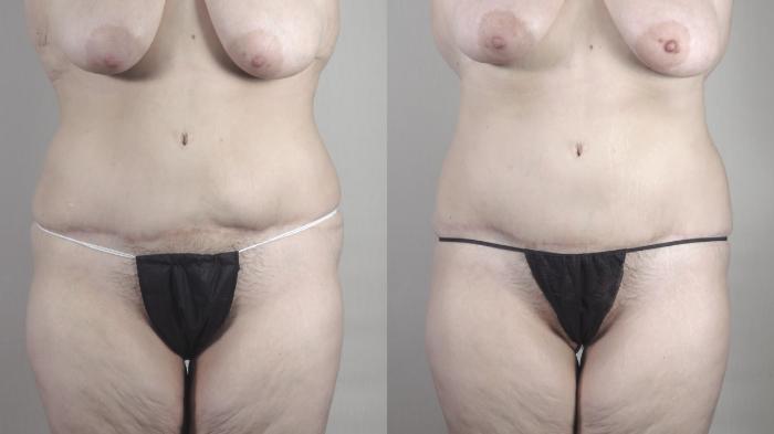 Tummy Tuck Case 1486 Before & After Front | Paramus, New Jersey | Parker Center for Plastic Surgery