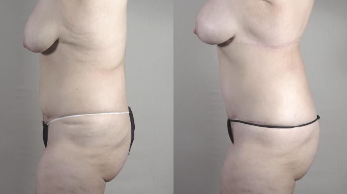 Tummy Tuck Case 1486 Before & After Left Side | Paramus, New Jersey | Parker Center for Plastic Surgery