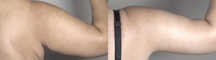 Tummy Tuck Case 1493 Before & After back arm 2 | Paramus, New Jersey | Parker Center for Plastic Surgery