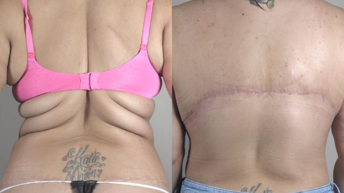 Tummy Tuck Case 1493 Before & After Back | Paramus, New Jersey | Parker Center for Plastic Surgery