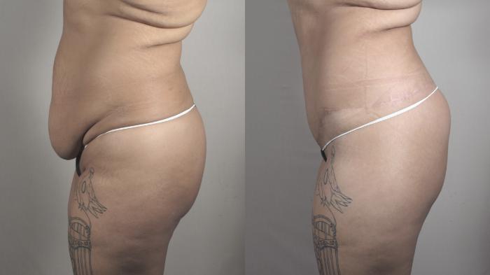 Tummy Tuck Case 1493 Before & After Left Side | Paramus, New Jersey | Parker Center for Plastic Surgery