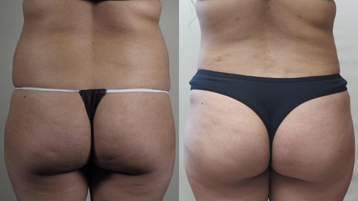 Tummy Tuck Case 1495 Before & After Back | Paramus, New Jersey | Parker Center for Plastic Surgery