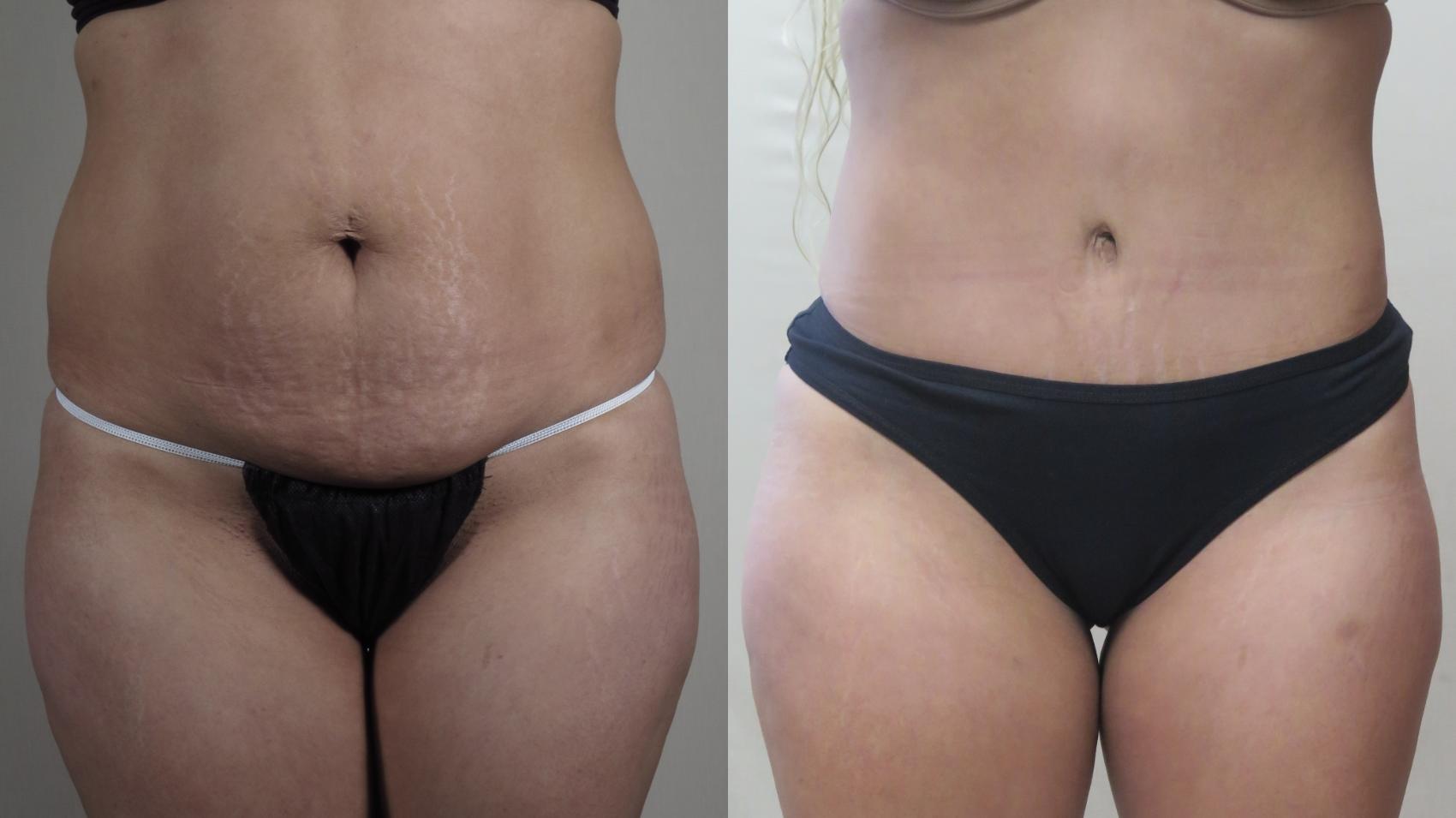 Tummy Tuck Case 1495 Before & After Front | Paramus, New Jersey | Parker Center for Plastic Surgery