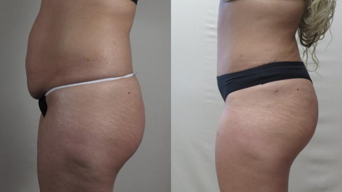 Tummy Tuck Case 1495 Before & After Left Side | Paramus, New Jersey | Parker Center for Plastic Surgery