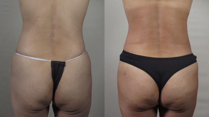 Tummy Tuck Case 1496 Before & After Back | Paramus, New Jersey | Parker Center for Plastic Surgery