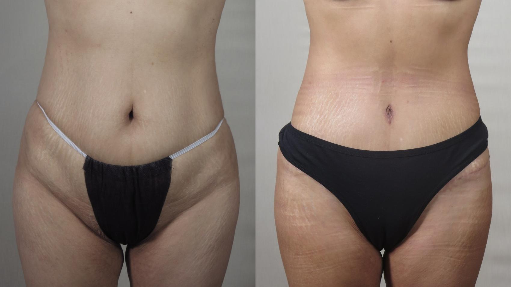 Tummy Tuck Case 1496 Before & After Front | Paramus, New Jersey | Parker Center for Plastic Surgery