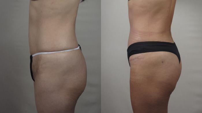 Tummy Tuck Case 1496 Before & After Left Side | Paramus, New Jersey | Parker Center for Plastic Surgery