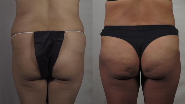 Tummy Tuck Case 1499 Before & After Back | Paramus, New Jersey | Parker Center for Plastic Surgery