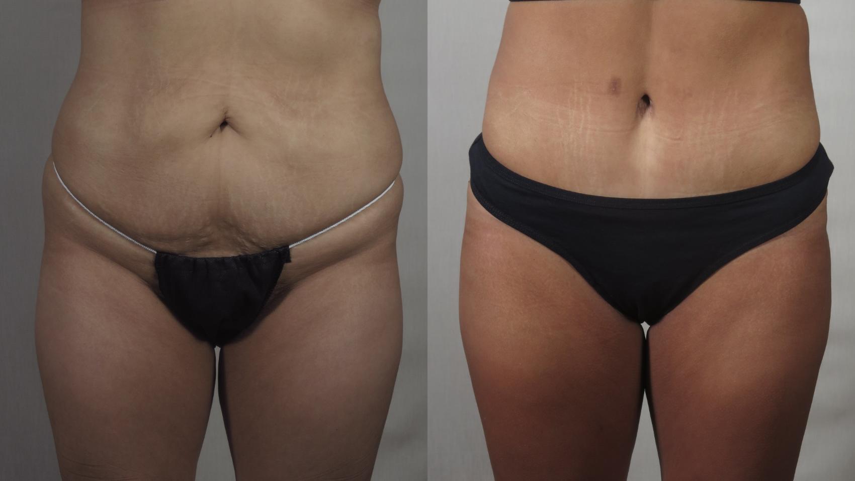 Tummy Tuck Case 1499 Before & After Front | Paramus, New Jersey | Parker Center for Plastic Surgery