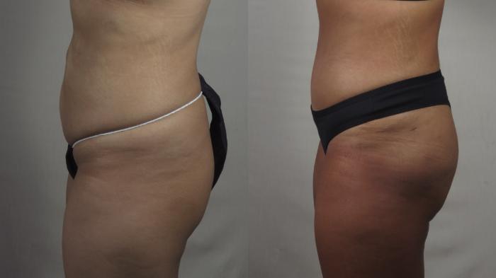 Tummy Tuck Case 1499 Before & After Left Side | Paramus, New Jersey | Parker Center for Plastic Surgery