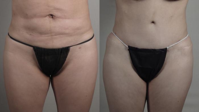 Tummy Tuck Case 1503 Before & After front 2 | Paramus, New Jersey | Parker Center for Plastic Surgery