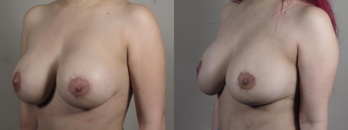 Tummy Tuck Case 1503 Before & After Left Oblique | Paramus, New Jersey | Parker Center for Plastic Surgery