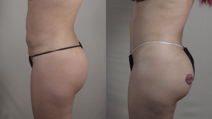 Tummy Tuck Case 1503 Before & After Left Side | Paramus, New Jersey | Parker Center for Plastic Surgery