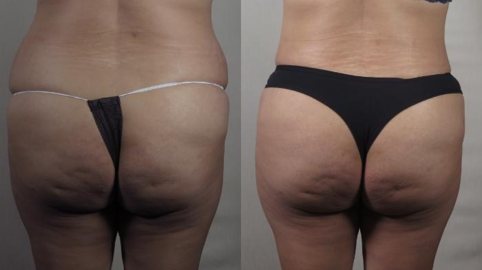 Tummy Tuck Case 1508 Before & After Back | Paramus, New Jersey | Parker Center for Plastic Surgery