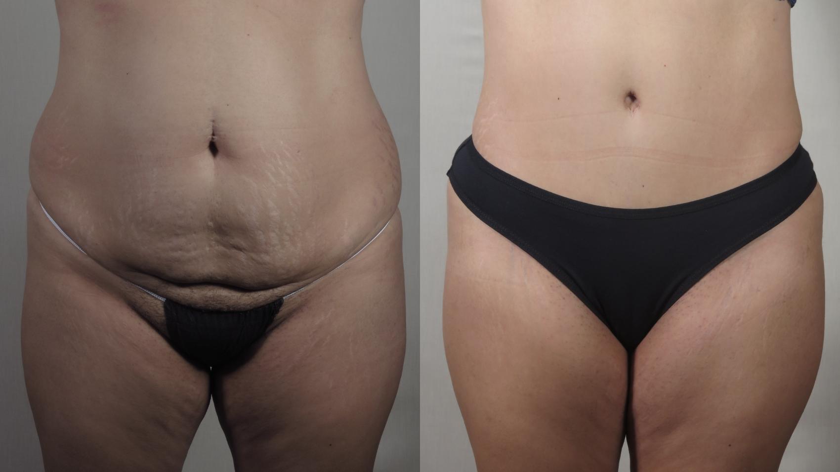 Tummy Tuck Case 1508 Before & After Front | Paramus, New Jersey | Parker Center for Plastic Surgery