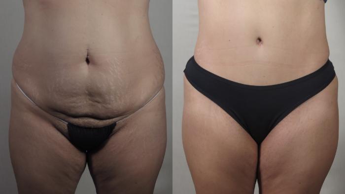 Tummy Tuck Case 1508 Before & After Front | Paramus, New Jersey | Parker Center for Plastic Surgery