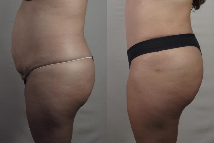 Tummy Tuck Case 1508 Before & After Left Side | Paramus, New Jersey | Parker Center for Plastic Surgery